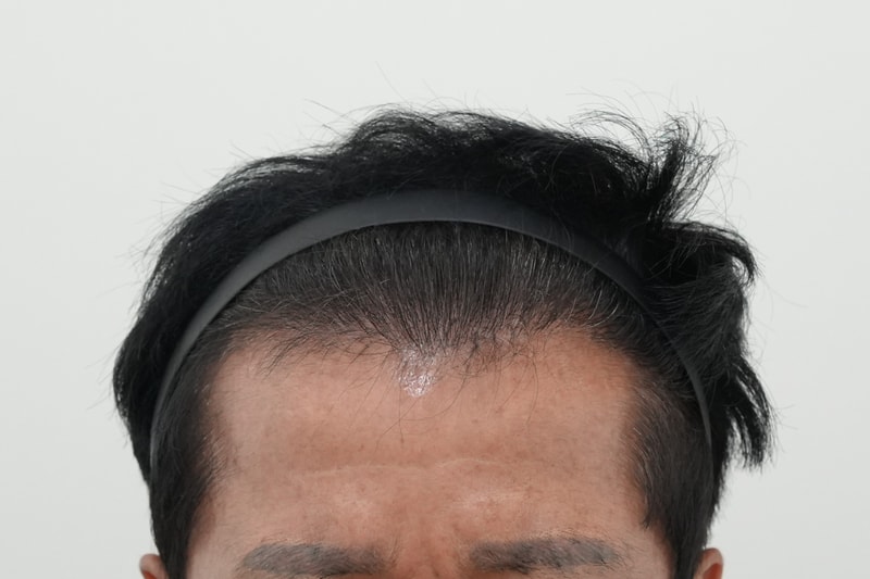 수술4년경과1.jpg
