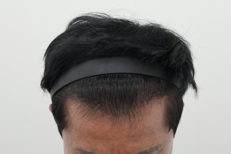 수술4년경과2.jpg