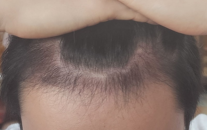 3. 수술후_3개월_셀카_1.jpg