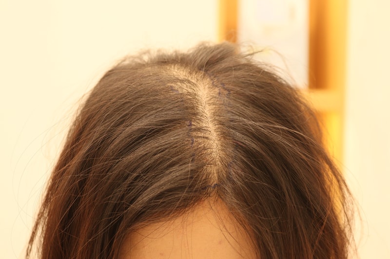 1. 수술전_2.JPG