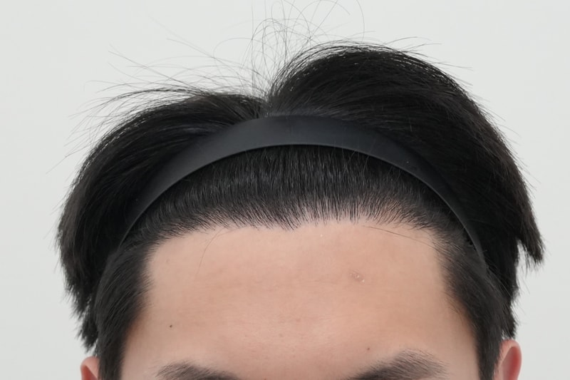 수술3.5년.jpg
