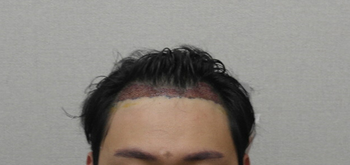 수술직후.JPG