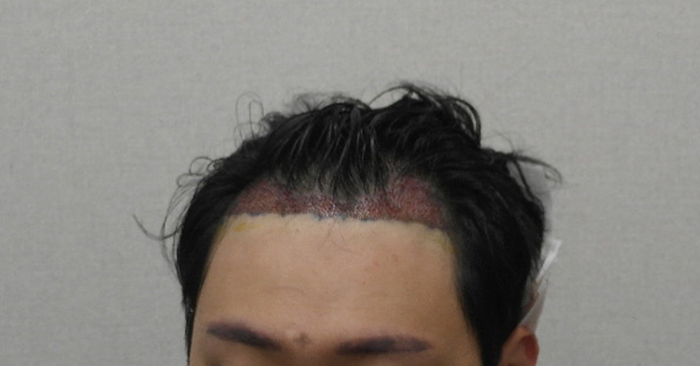 수술직후3.JPG