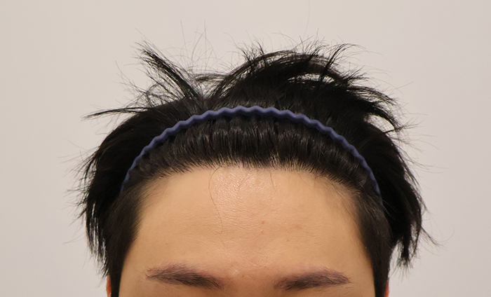 수술 1년4개월.JPG