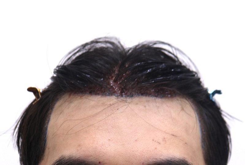2. 수술후_1일_1.JPG
