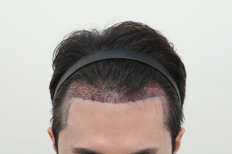 수술직후.jpg