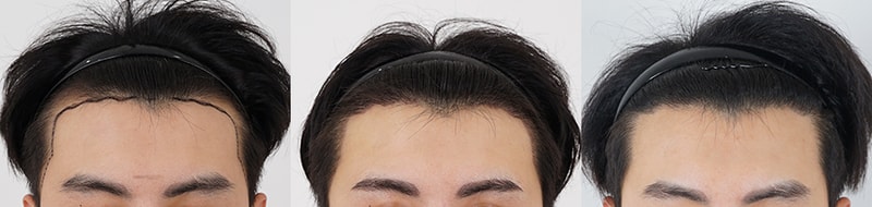 압구정모발이식 10개월 후기 / 모모성형외과 절개 2700모 
