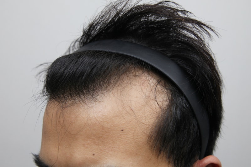 모나라모발이식 (3).jpg