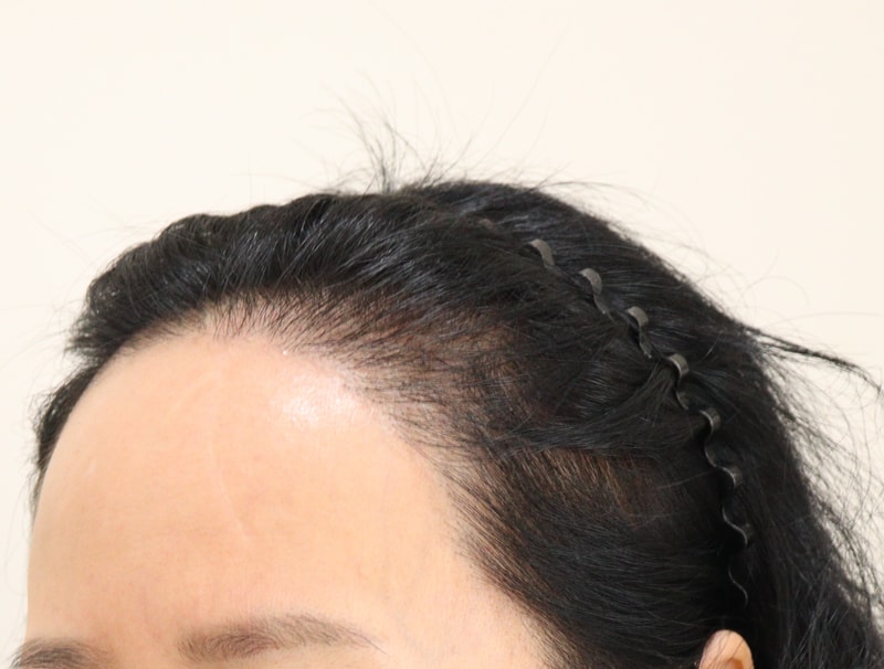 1. 수술전_2.JPG