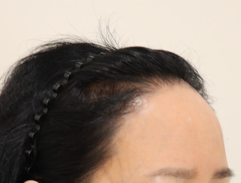 1. 수술전_3.JPG