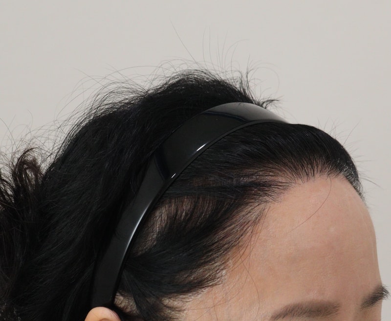 4. 수술후_1년_3.JPG