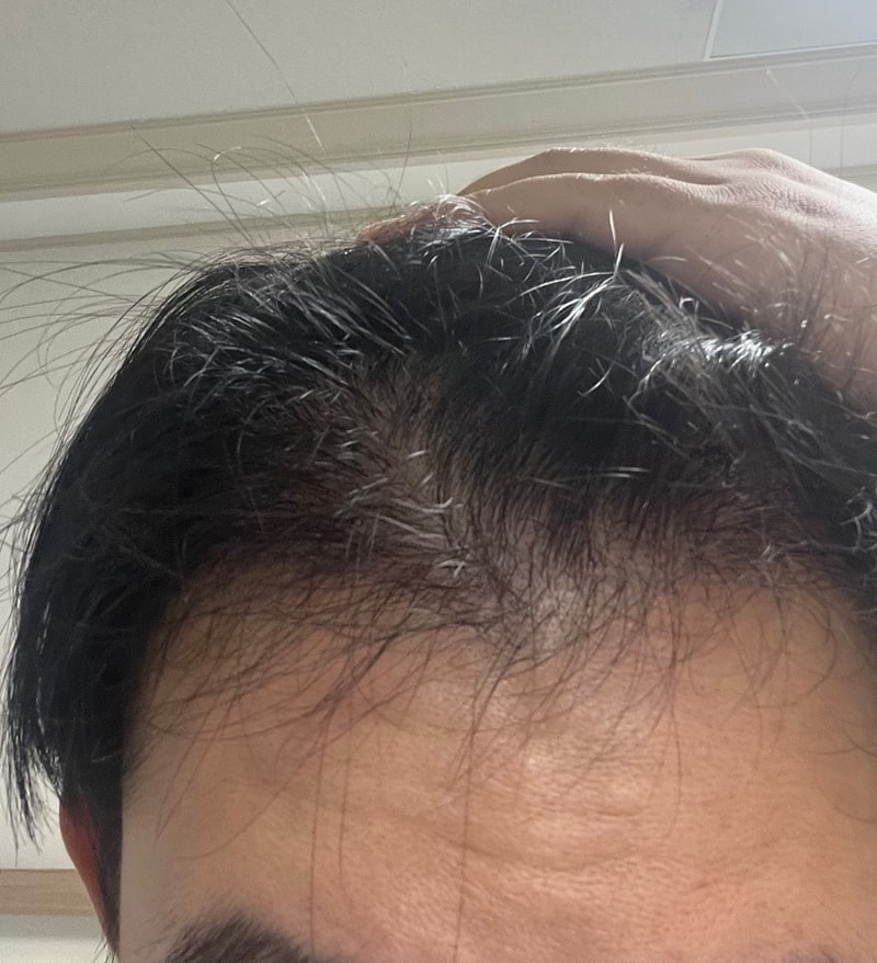 4. 수술후_6개월_셀카_1.jpeg