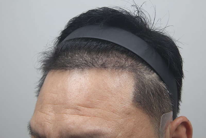 모나라피부과_모발이식-(5).jpg