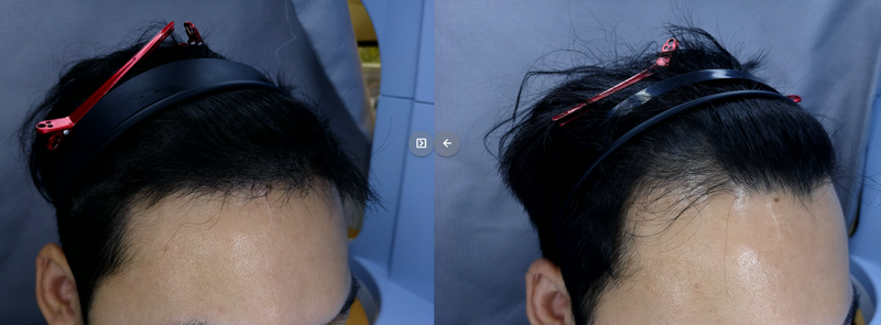 3mo+전 측면.png