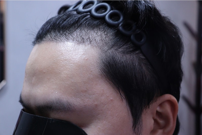 압구정모비앙의원 모발이식 2주 경과 후기