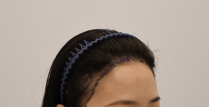 03.수술전디자인.JPG