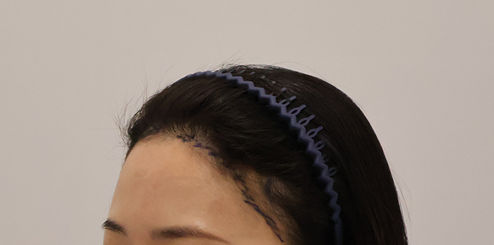 04.수술전디자인.JPG