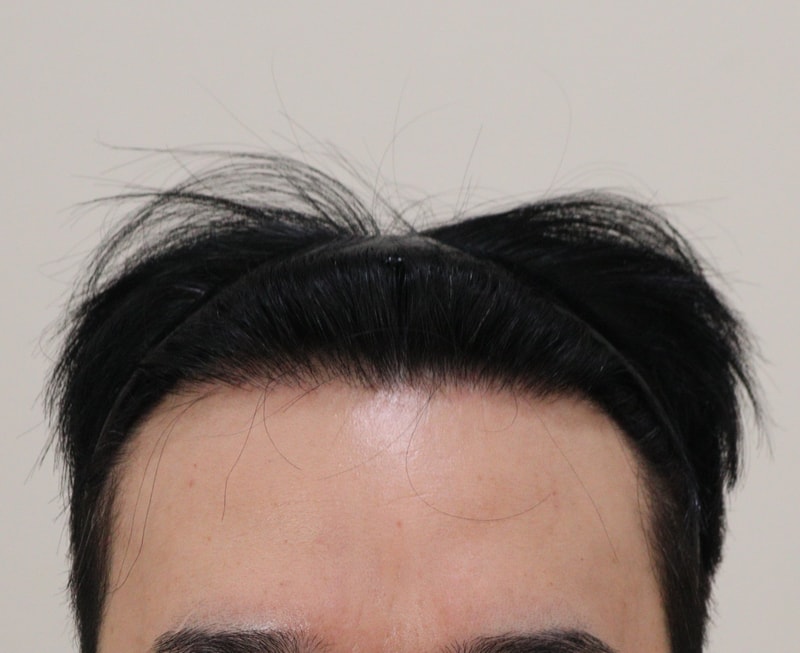 4 수술후_1년_1.JPG
