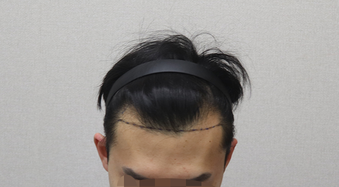 02.수술전디자인.JPG