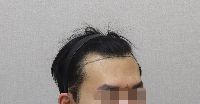 03.수술전디자인.JPG