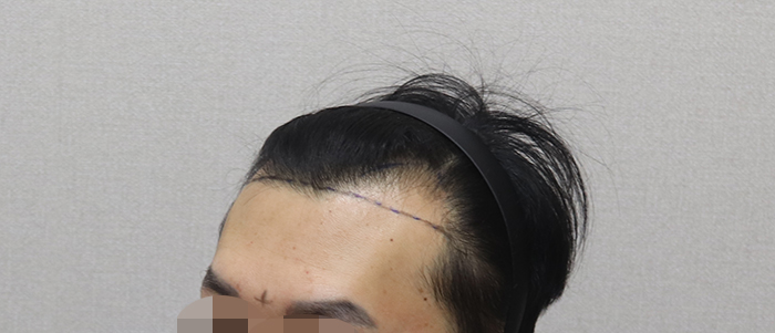 04.수술전디자인.JPG