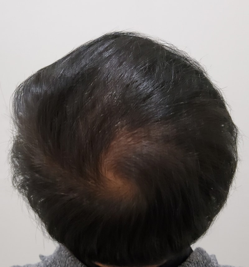 4. 수술후_1년_3.jpg