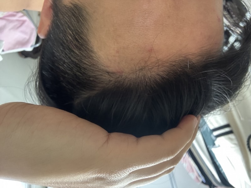 Late stage of 9th month of incisional hair transplantation and tips related to hair transplantation