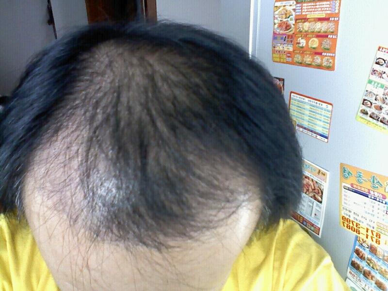 수술후2개월.jpg