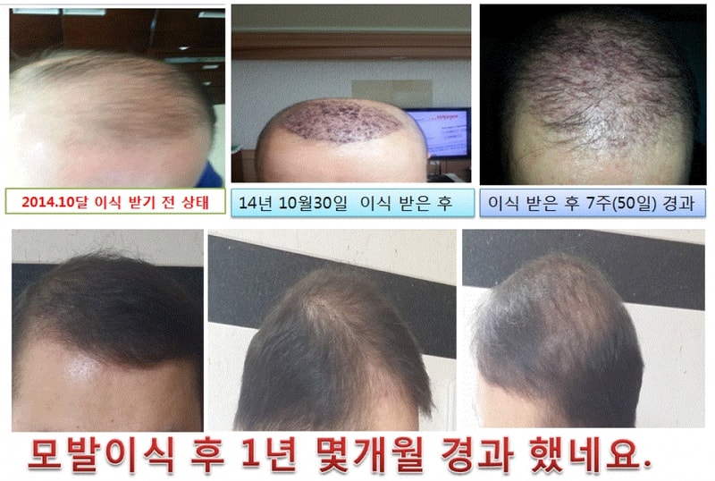 모발이식후 1년 경과되어 후기 남겨봅니다..