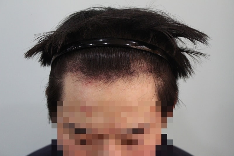 수술후 한달 (1).JPG