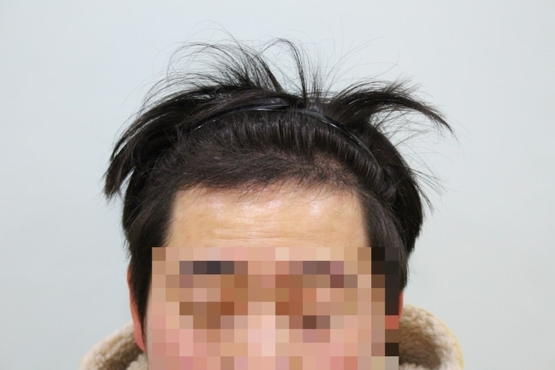 수술후 3개월 (4).JPG