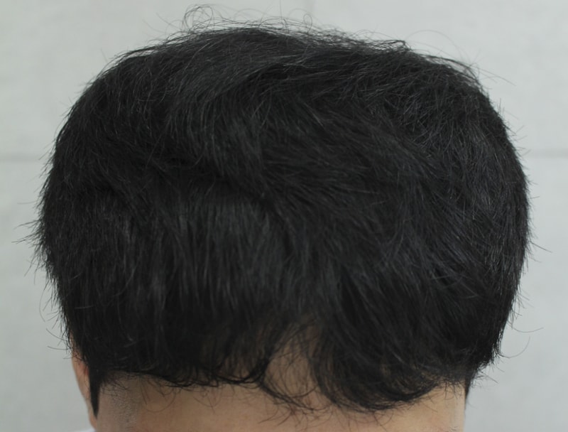 헤어라인 이식한지 이제 9개월 되었어요!!