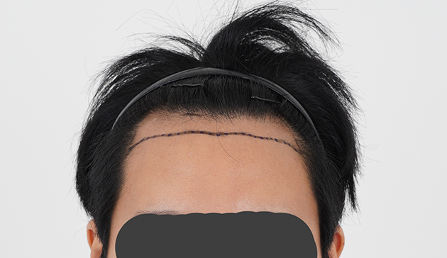 2600모 수술 11개월 득모후기요