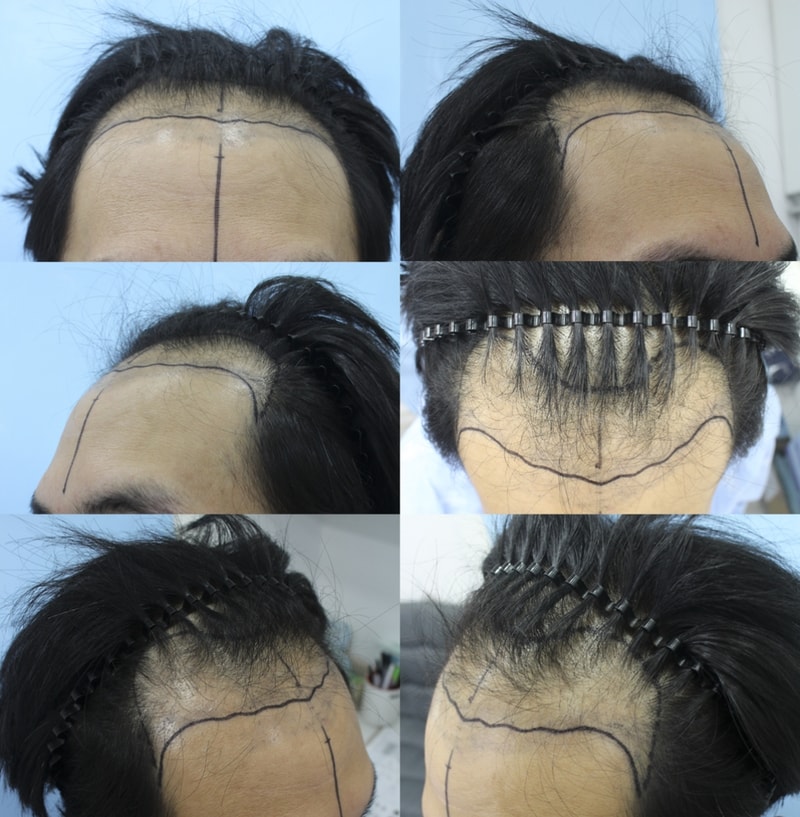 절개로 이식한지 4개월이 되었어요