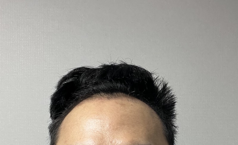다나 비절개 무삭발 2개월