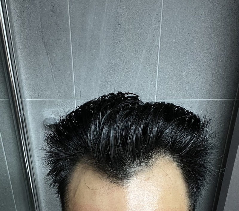 다나 심한 M자 무삭발 모발이식 6개월 간의 앞 머리 변화 모음