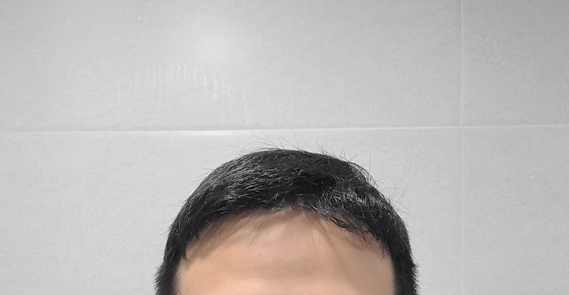술후 정면.jpg