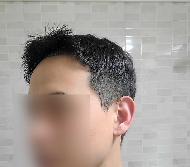 다나 유승현원장님 추천,3000모,비절개모발이식,2년차