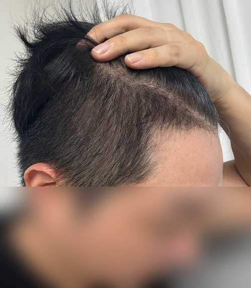 무삭발모발이식 다나성형외과 22개월/수술전에 다 따져보고 받았습니다!