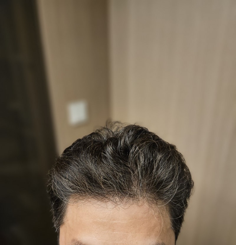 다나 무삭발 모발이식 7개월 후기