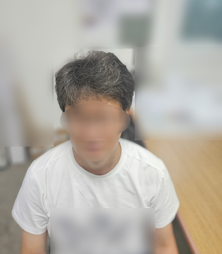 정수리모발이식과 엠자이식 같이 받았어요. 다나성형외과 19개월차입니다.