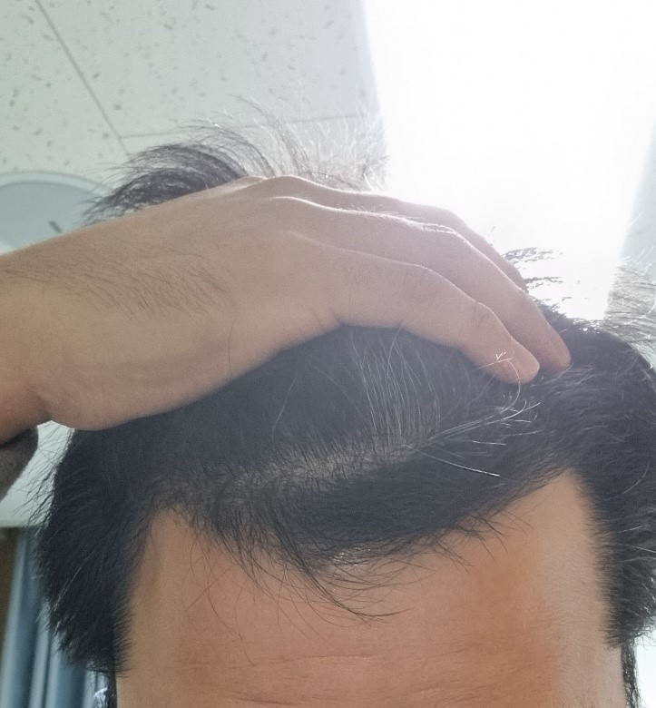 다나 심한 엠자 4개월 경과. 이게 되네요!