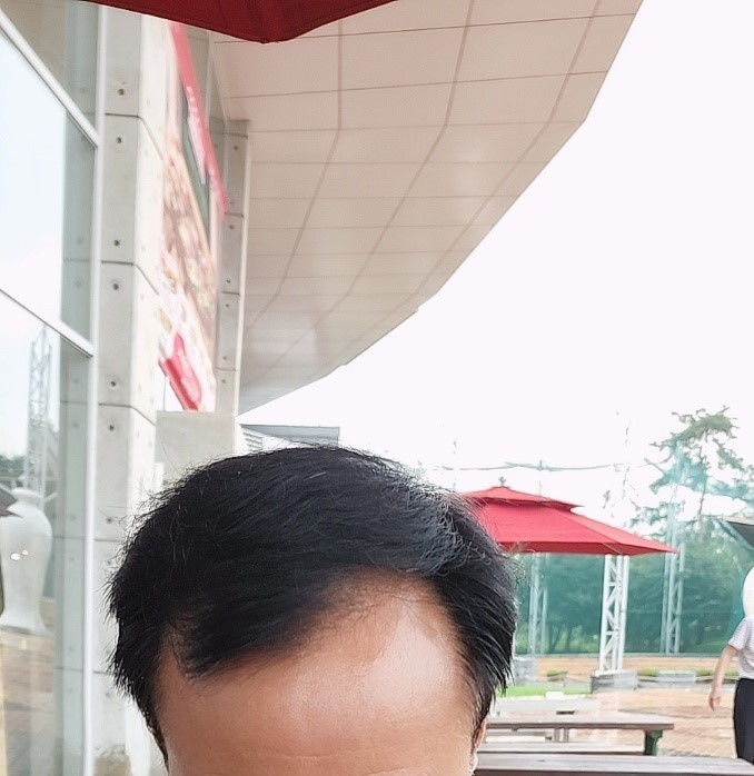 다나 무삭발 2700모낭 6개월 후기