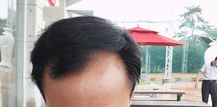 다나 무삭발 대량모발이식 13개월 후기