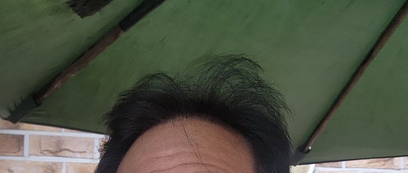 다나 비절개 대량모발이식 16개월차입니다