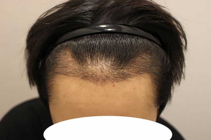 수술후 15일 (9).JPG