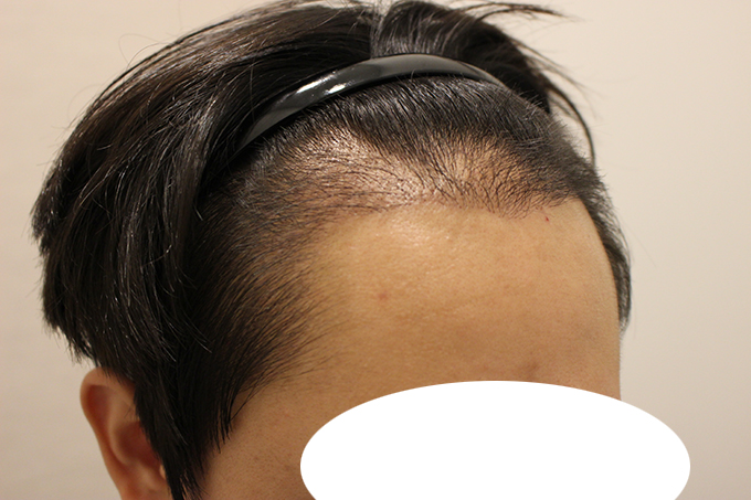 수술후 15일 (2).JPG