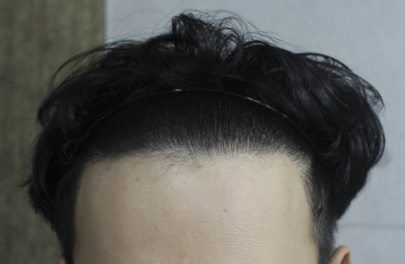 헤어라인 이식 1년이 됐어요