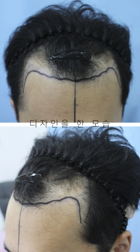 절개 3500모 헤어라인+전두부 이식 1년 됐습니다