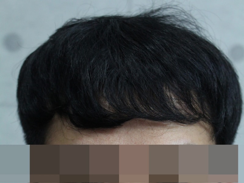수술후 4개월__머리 내렸을때.JPG